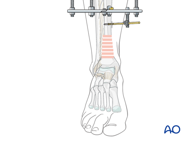 Four ring frame designing with spread along entire length of tibia