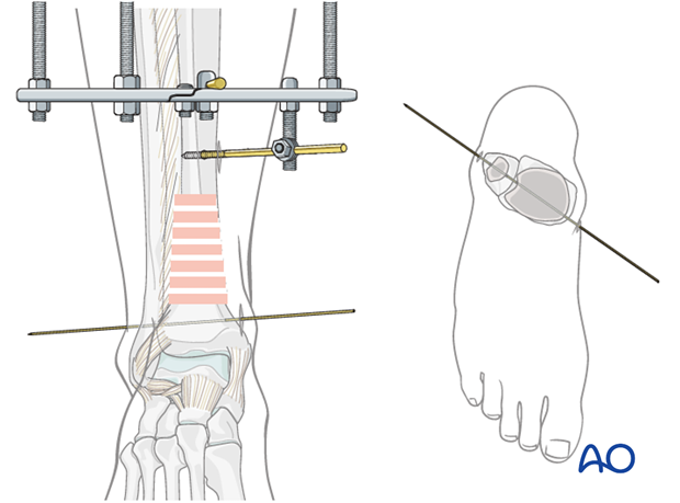 Full ring external fixation (Ilizarov) for Extraarticular, wedge