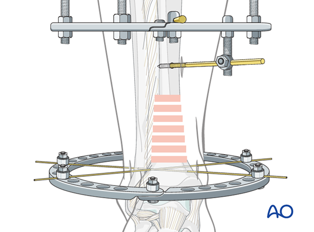 Full ring external fixation (Ilizarov) for Extraarticular, wedge fracture