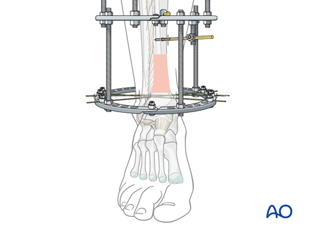 Ring external fixator (definitive) for Complete articular fracture