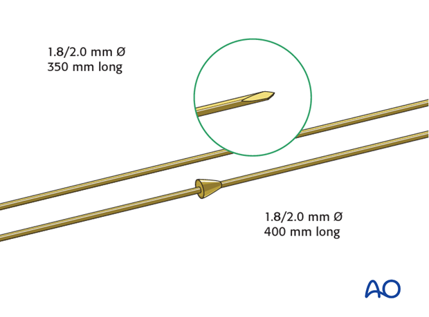 Full ring external fixation (Ilizarov) for Extraarticular, wedge fracture