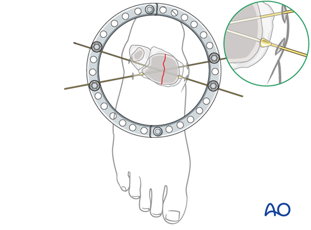 Use of reduction wires for full ring external fixation to compress articular fragments