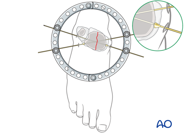 Full ring external fixation (Ilizarov) for Extraarticular, wedge fracture