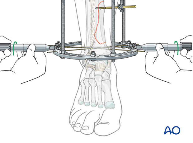 Tensioning of reduction wires in full ring external fixation