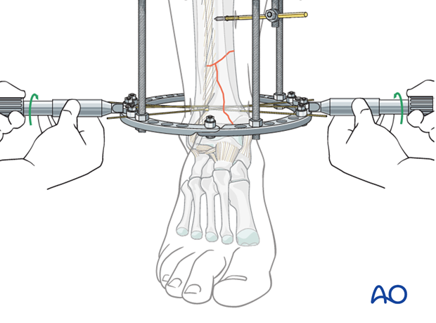 Orthopedic Fixation Ilizarov Ring External Fixator for Tibia &Femur