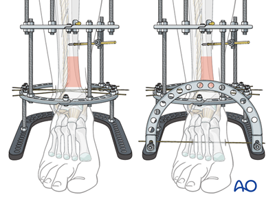 Full ring external fixation (Ilizarov) for Extraarticular, simple fracture