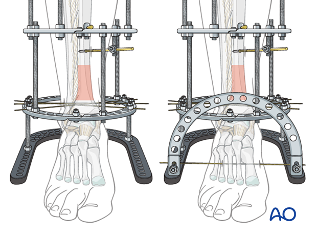 Frame extension to calcaneus and forefoot in full ring external fixation
