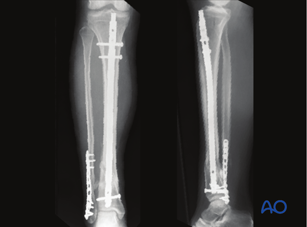 Radiographic example of nailing to treat a distal tibia fracture
