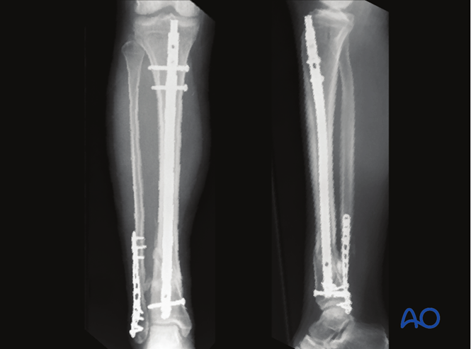 MIO - Intramedullary nail for Extraarticular, simple fracture