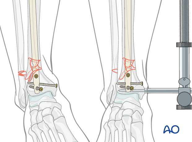 Nail insertion and reduction of a distal tibia fracture