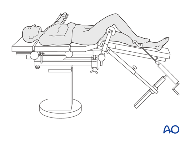 Patient positioning on a traction table