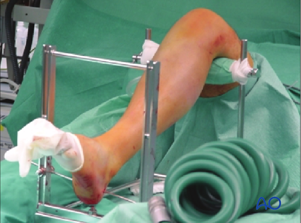 Mobile reduction frame for traction of distal tibia