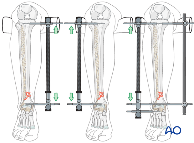 Large distractor positioning before intramedullary nailing to treat distal tibia fracture