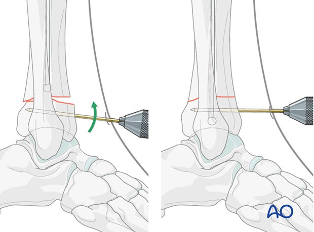 Pin (joystick) positioning before intramedullary nailing to treat distal tibia fracture