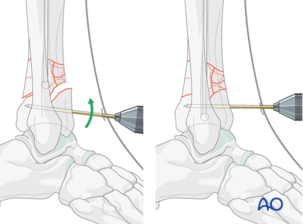 Pin (joystick) positioning before intramedullary nailing to treat distal tibia fracture