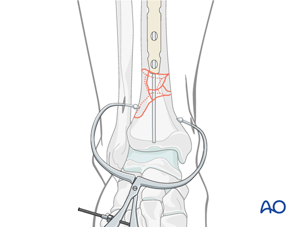 Insertion of cannulated nail for distal tibia fracture fixation