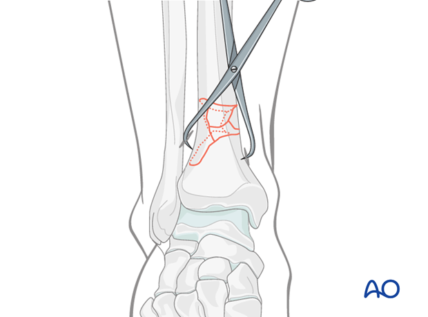 Treatment of undisplaced intraarticular distal tibia fracture