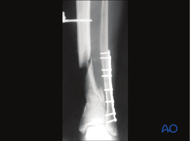 Radiograph of reduction and fixation of a fibula fracture associated with a distal tibia fracture