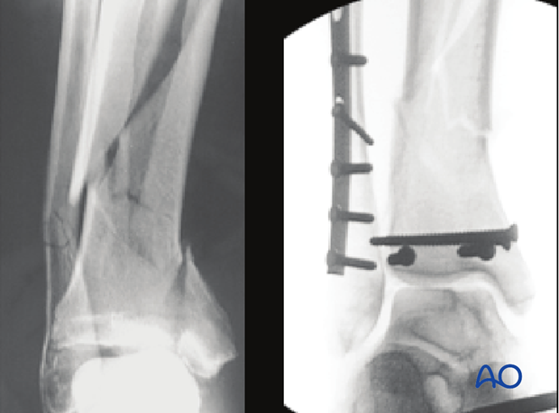 Radiograph of reduction and fixation of a fibula fracture and screw fixation of a distal tibia fracture