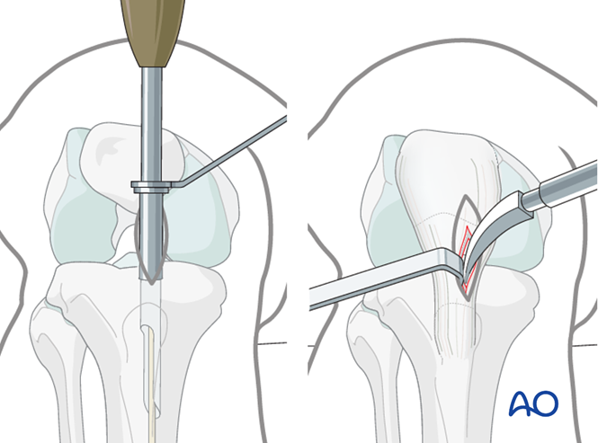 MIO - Intramedullary nail for Extraarticular, simple fracture