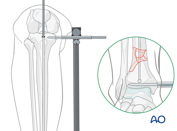 Guide wire for intramedullary nailing to treat distal tibia fracture