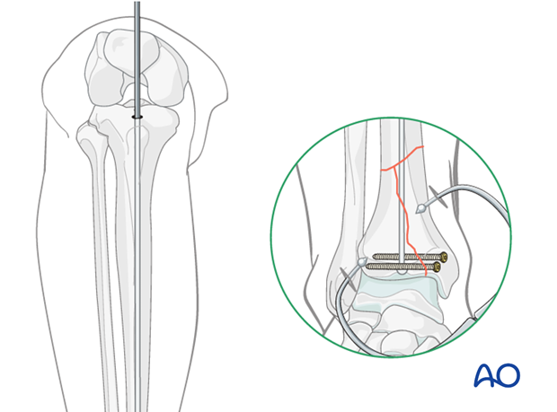 Guide wire for intramedullary nailing to treat distal tibia fracture