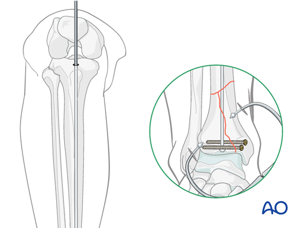 A Review of Proximal Tibia Entry Points for Intramedullary Nailing