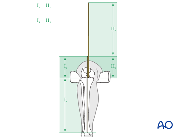 Guide wires for intramedullary nail length measurement