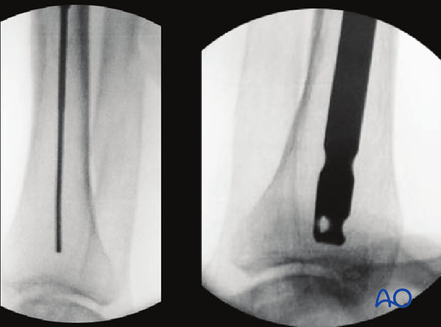 Fluoroscopic control of intramedullary nail positioning in distal tibia