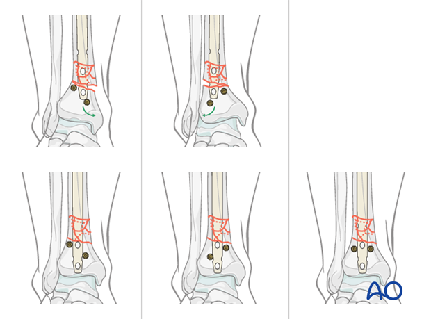 Use of Poller screw in tibial intramedullary nailing