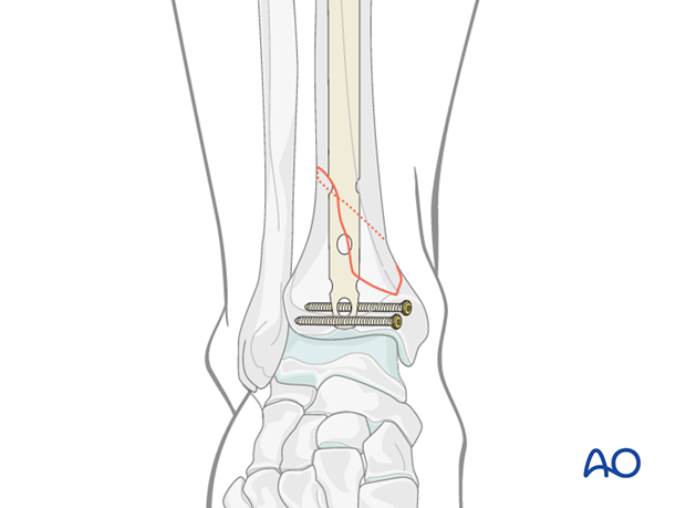 Treatment of undisplaced intraarticular distal tibia fracture