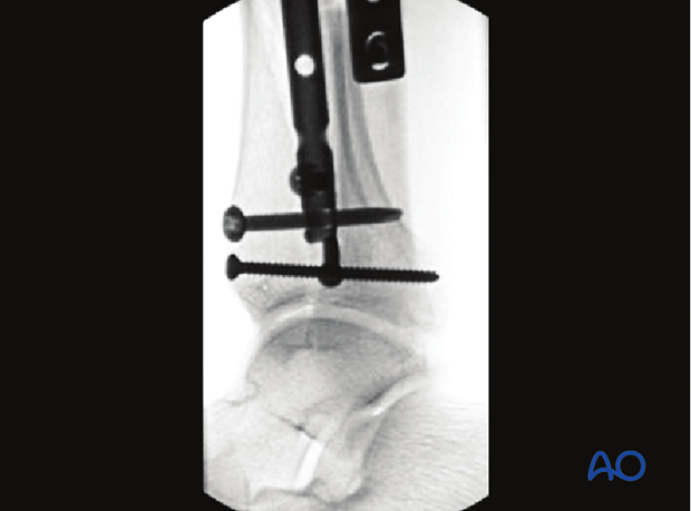 Radiographic example of treatment of undisplaced intraarticular distal tibia fracture