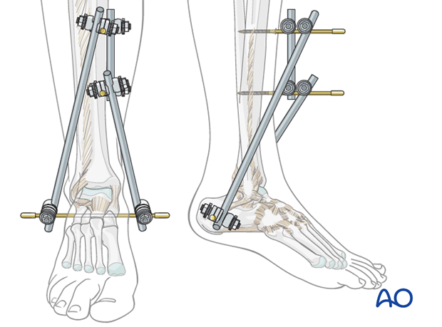 Tibiocalcaneal frame construction for triangular external fixation