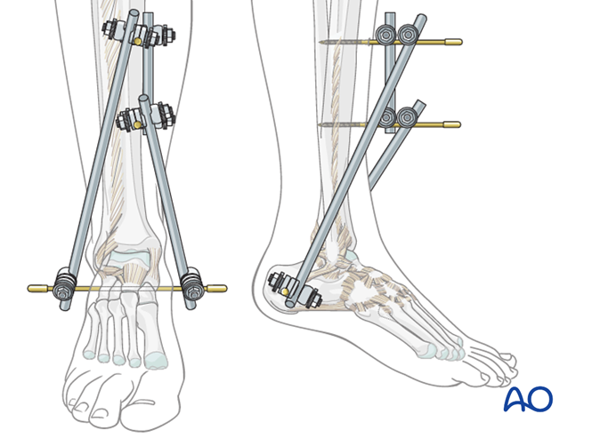 Temporary joint-bridging triangular external fixation for Complete ...