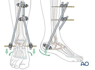 Temporary joint-bridging triangular external fixation for Complete ...