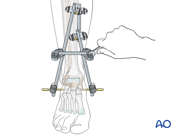 Rod connection for stabilization of tibial triangular external fixation
