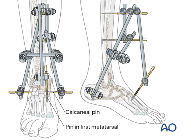 Joint-bridging triangular external fixation in the distal tibia