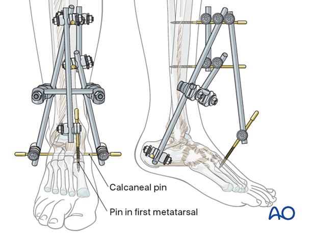 TIBIA BY HYBRID FIXATION