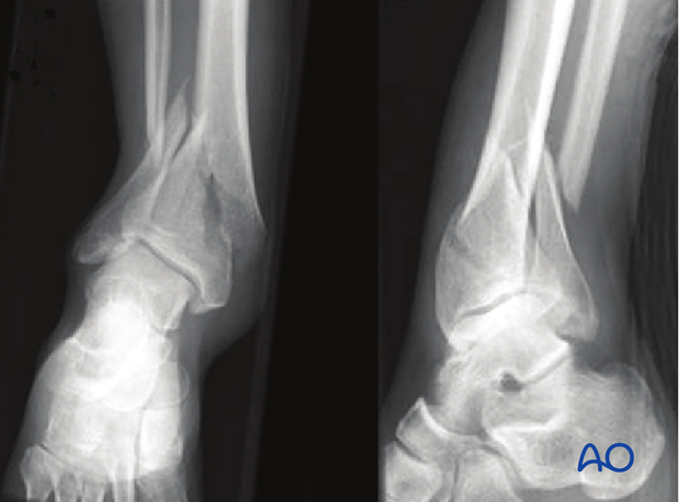 Distal Tibia Plate Surgical Technique