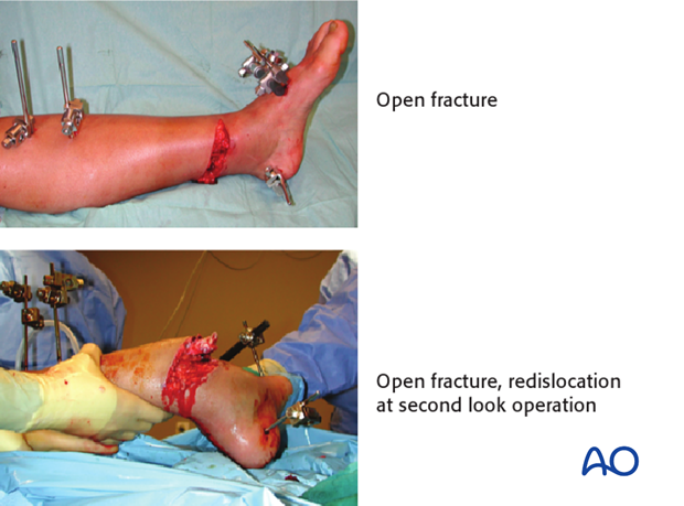 Example of open pilon fracture