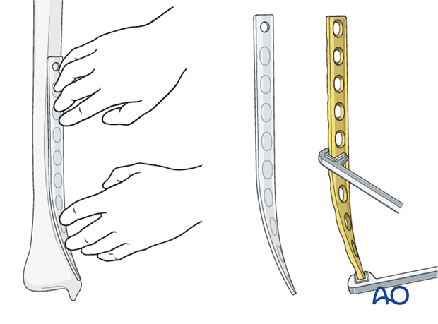 Plate contouring for internal fixation of distal tibia fracture