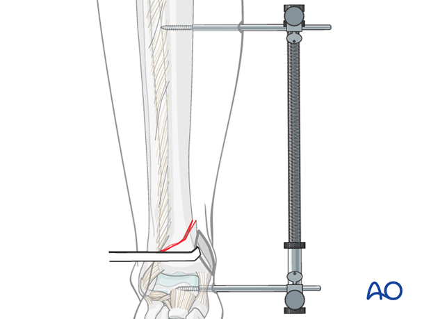 Indirect reduction of distal tibia fracture with a distractor