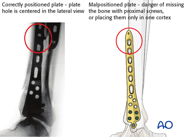 Distal Tibia Plate Surgical Technique