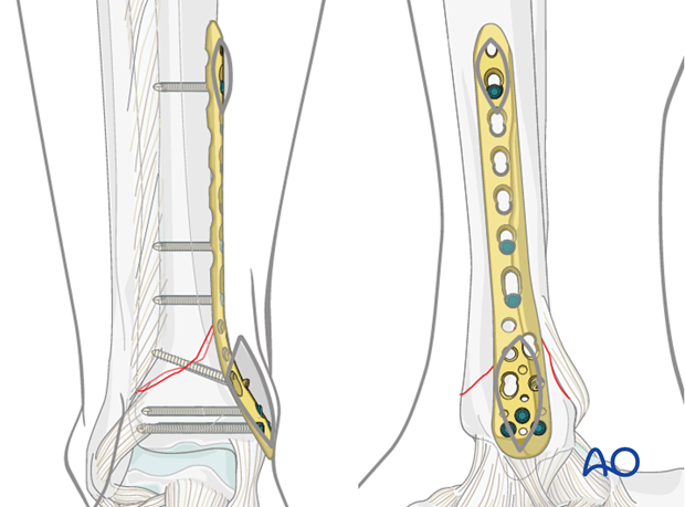 Distal Tibia Plate Surgical Technique