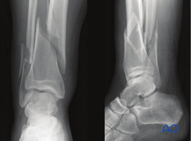 Radiographic example of extraarticular distal tibia fracture