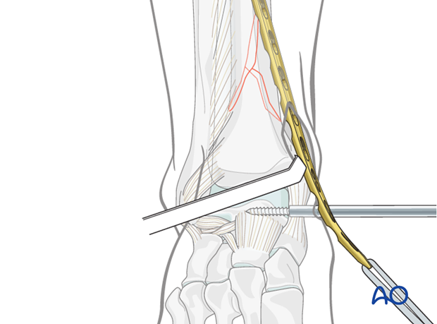 MIO plate insertion to treat distal tibia fracture