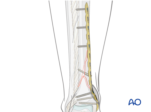 Screw positioning for distal tibia MIO