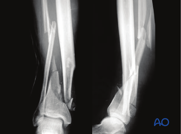 Radiographic example of extraarticular distal tibia fracture