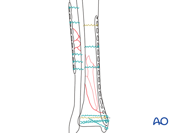 Preoperative planning for treatment of distal tibia fracture