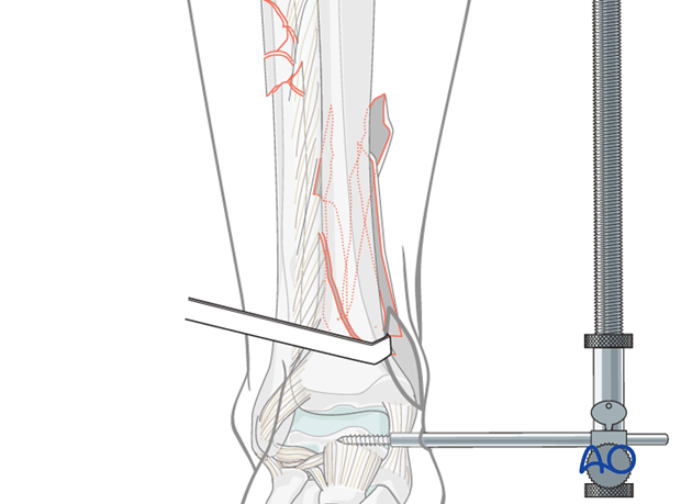 Indirect reduction of distal tibia fracture with a distractor